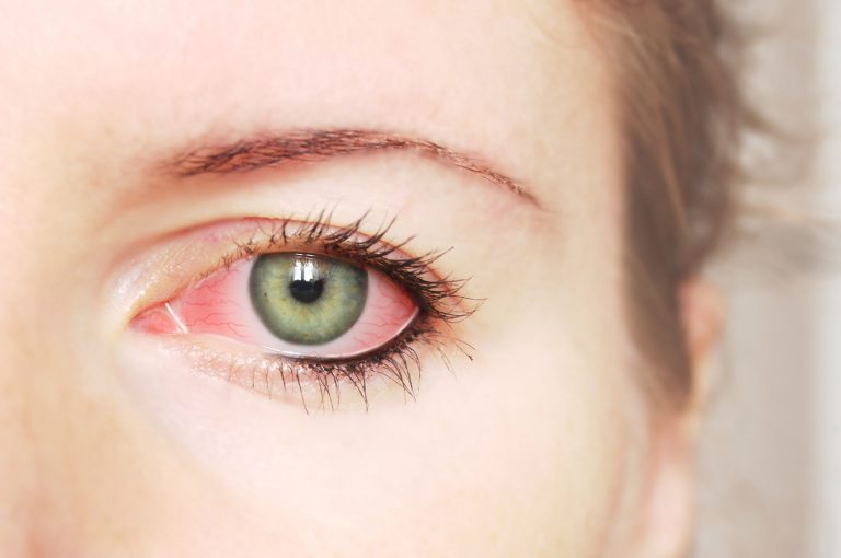 Vrouw met rode, jeukende ogen die last heeft van allergie op het oog